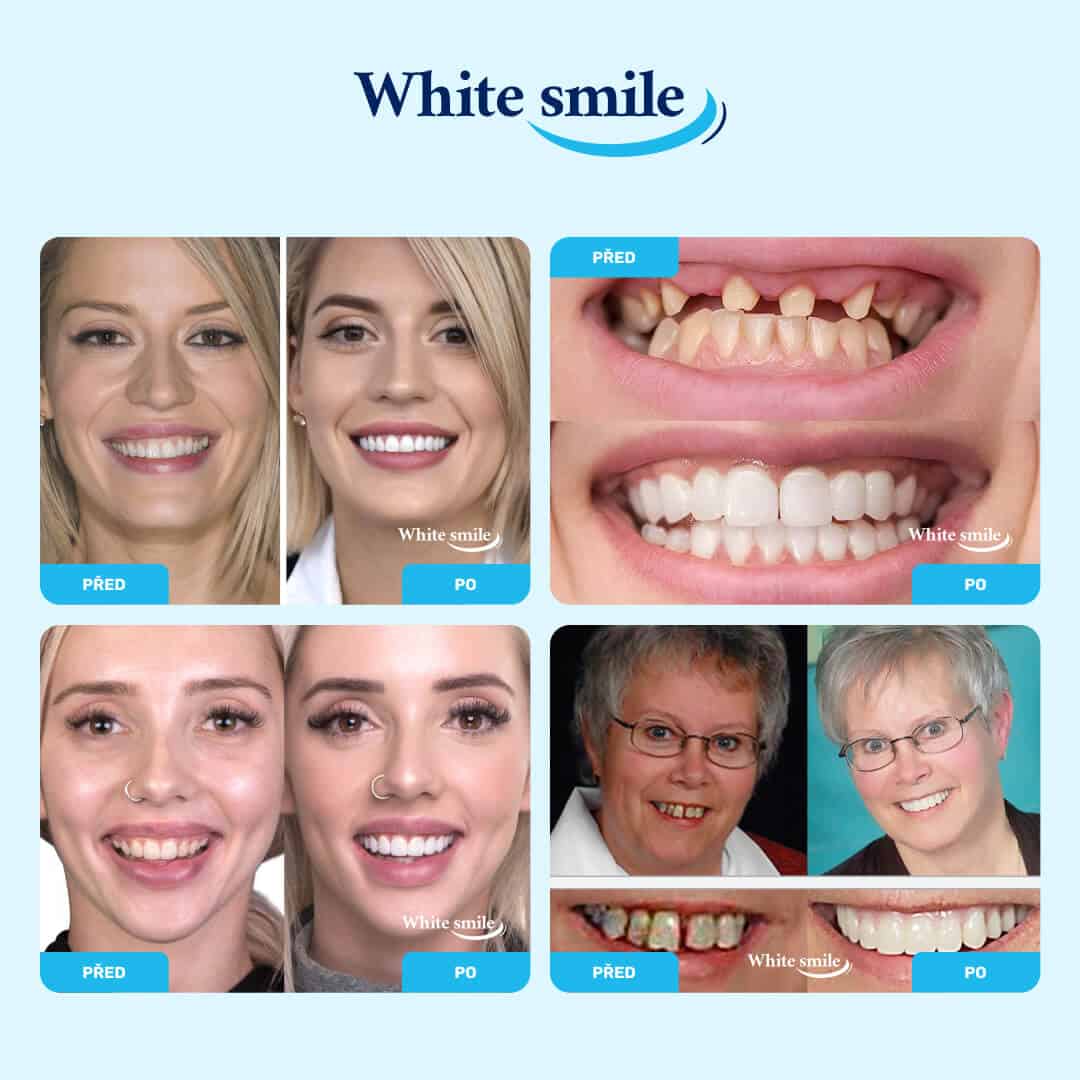 WHITESMILE™ – Nastavitelná Kosmetická Zubní Fazeta - Obrázek 2